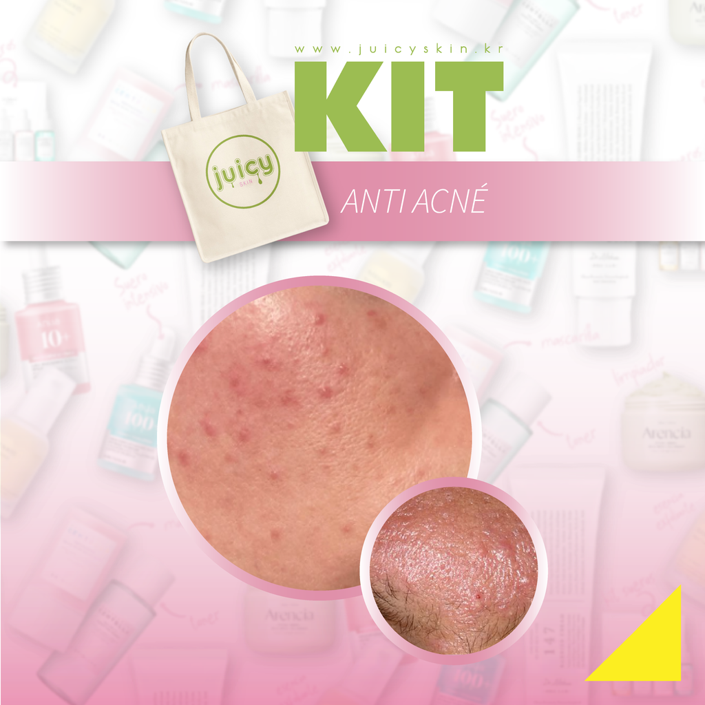 Kit Anti Acné | Purifica, Controla Brotes y Calma la Piel - 4 piezas